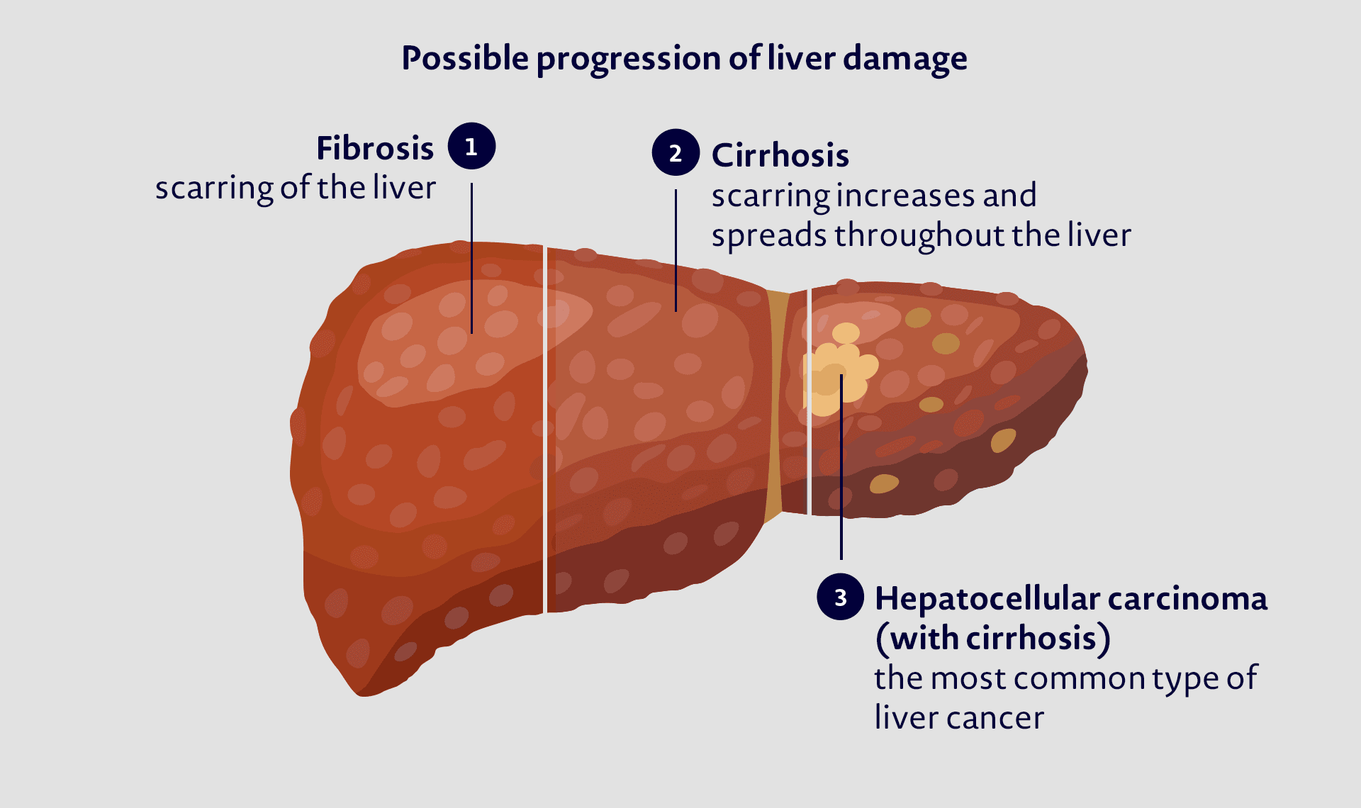 Liver - Damaged